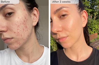 My acne cleared after moving